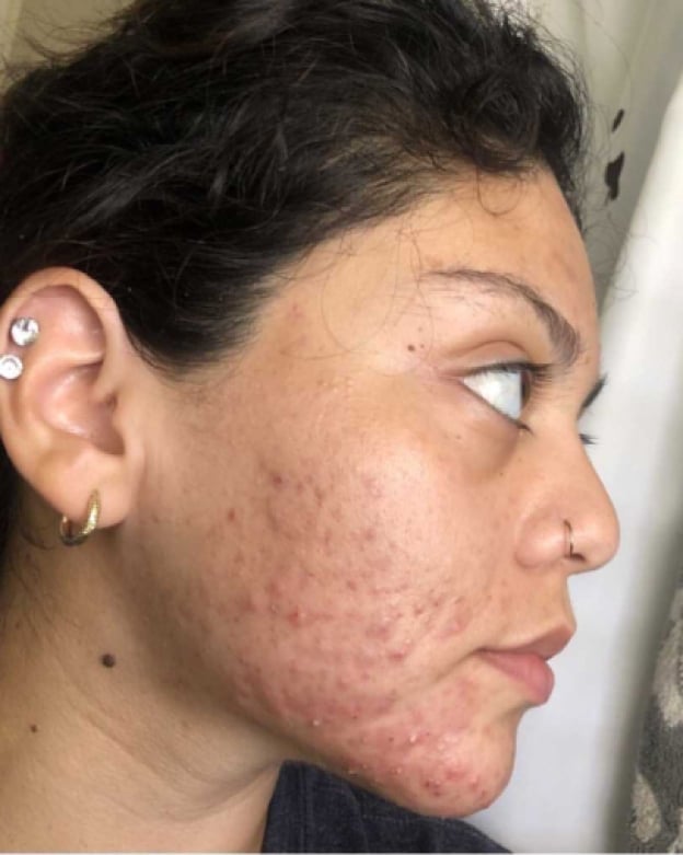 Brunette woman with curly hair and nose ring, facing to the left, before Curology use.