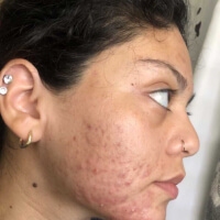 Brunette woman with curly hair and nose ring, facing to the left, before Curology use.