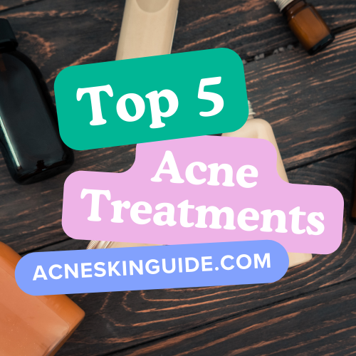 Top 5 Acne Treatments