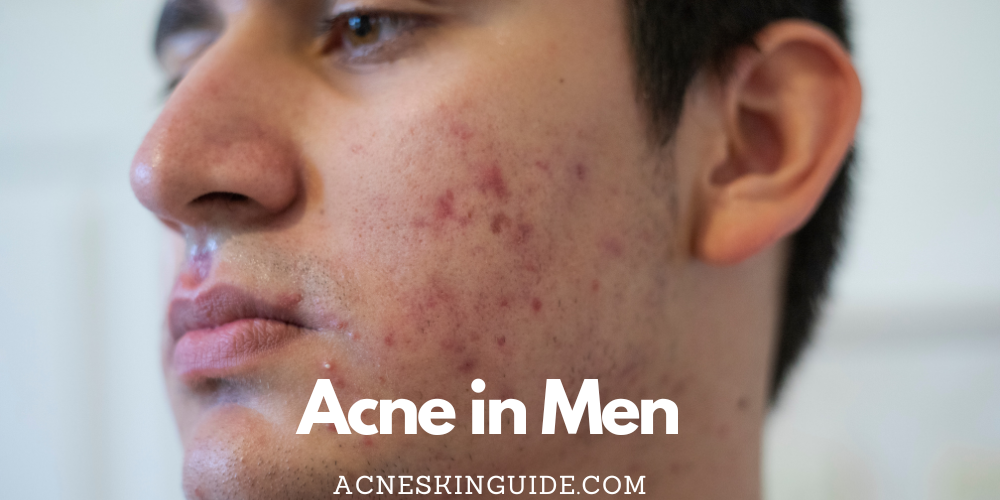 Acne in Men