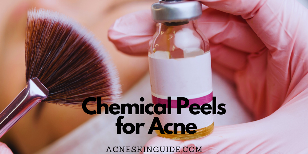Chemical Peels for Acne