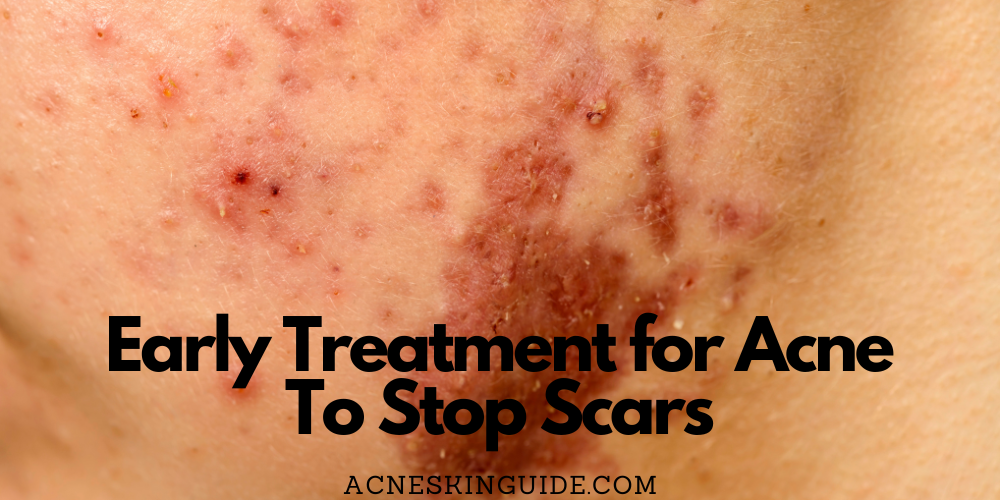 Early Treatment for Acne
