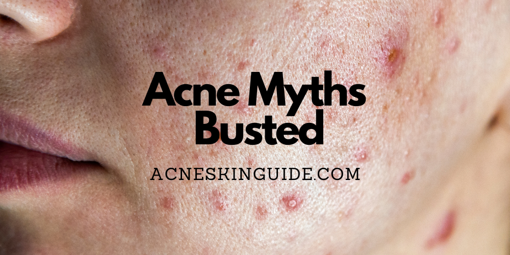 Acne Myths Busted