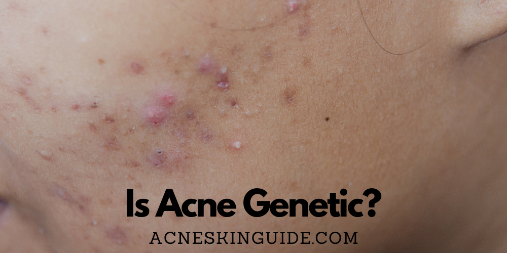 Is Acne Genetic