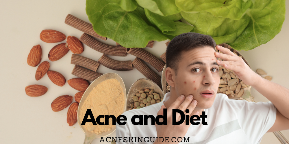 Acne and Diet