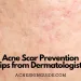 Acne Scar Prevention