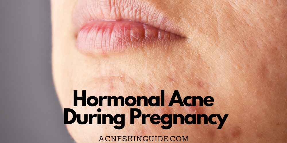 Hormonal Acne During Pregnancy