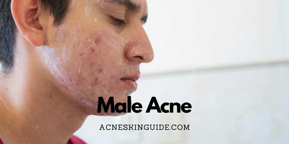 Male Acne