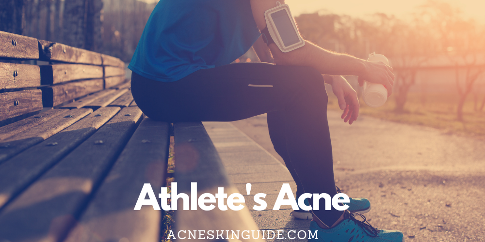 Athlete's Acne