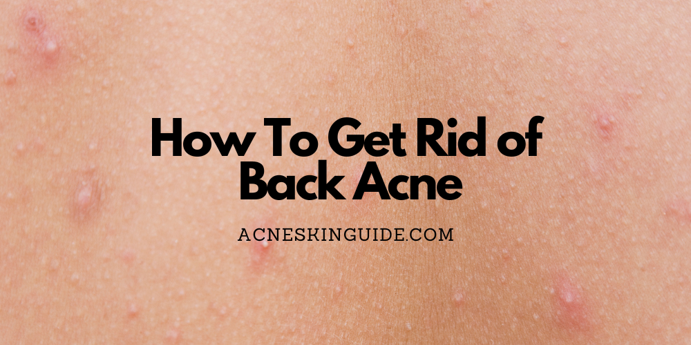 How To Get Rid of Back Acne