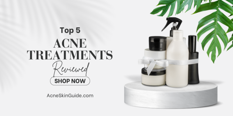 Top 5 Best Acne Spot Treatments