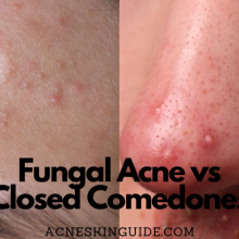 Fungal Acne vs Closed Comedones