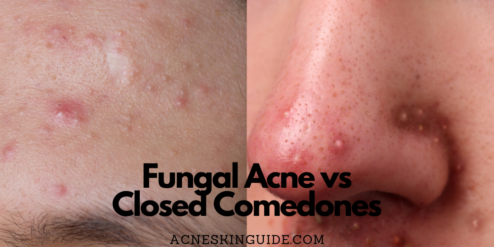Fungal Acne vs Closed Comedones