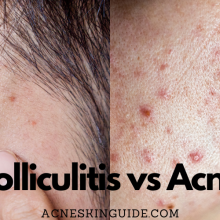 Folliculitis vs Acne