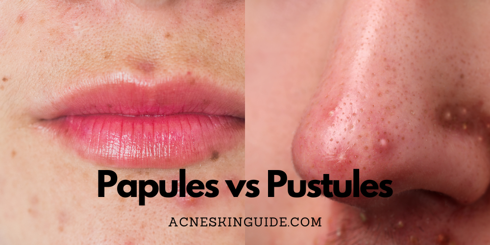 Papules vs Pustules