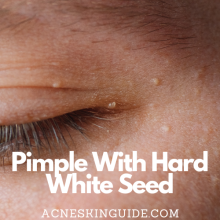 Pimple With Hard White Seed