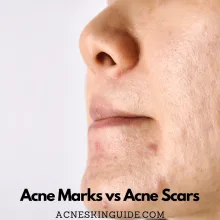 Acne Marks vs Acne Scars