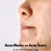 Acne Marks vs Acne Scars