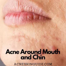 Acne Around Mouth and Chin