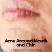 Acne Around Mouth and Chin